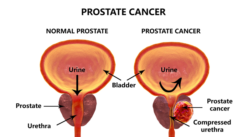 Blocages a prosztatitis